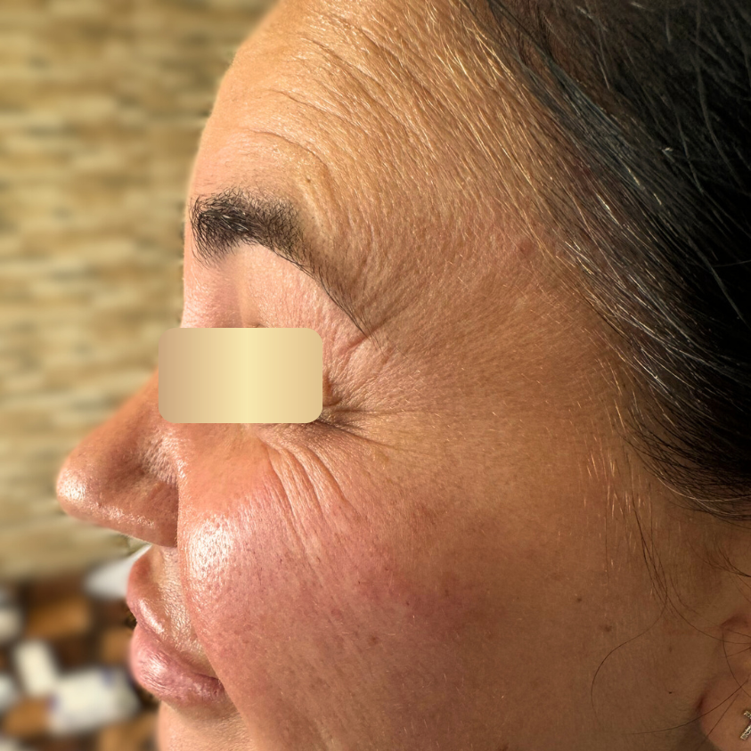 Expression Lines and Deep Wrinkles before