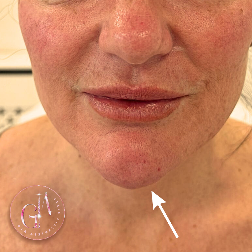 Chin balance after