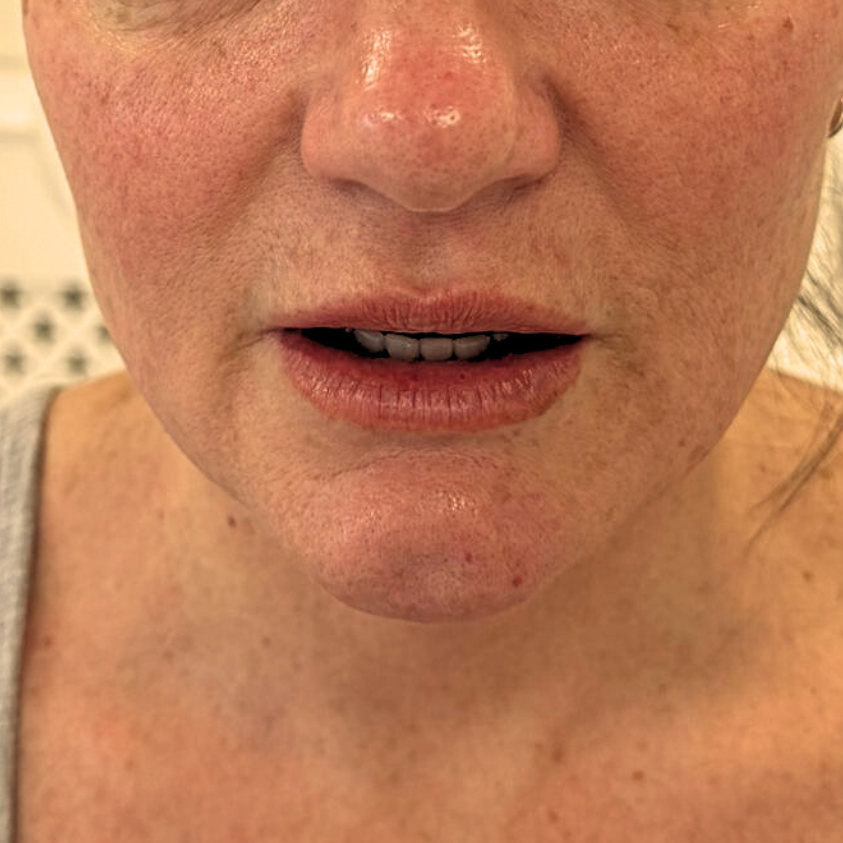 Chin balance before