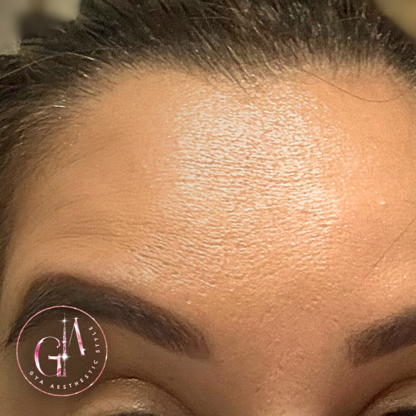 Forehead Strong Wrinkles and Fine Lines after