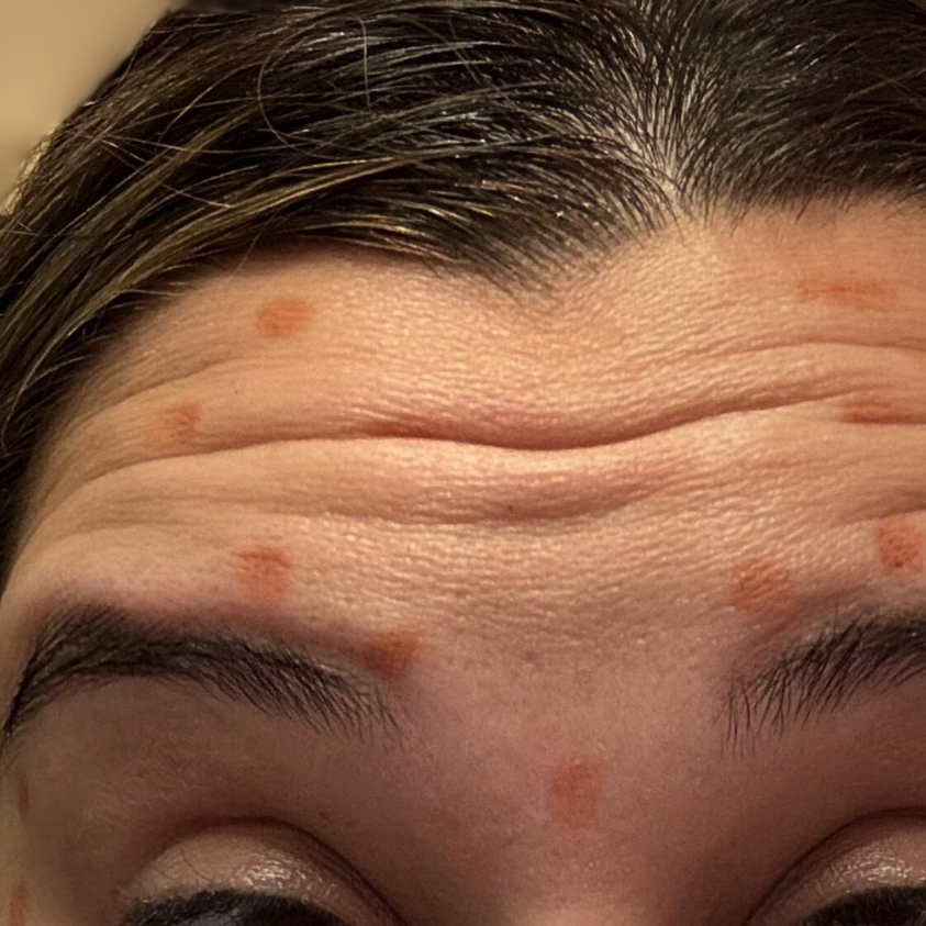 Forehead Strong Wrinkles and Fine Lines before