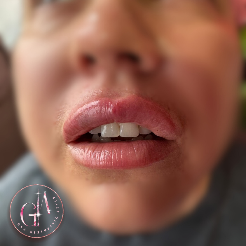 Lip Volume and hydration after