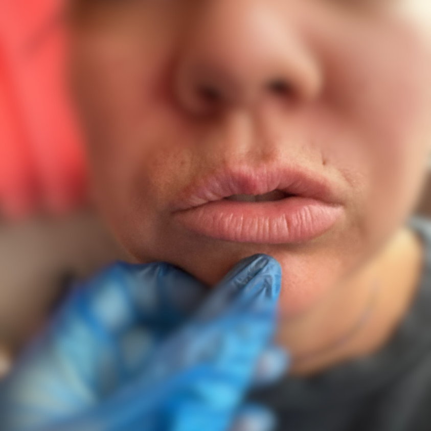 Lip Volume and hydration before
