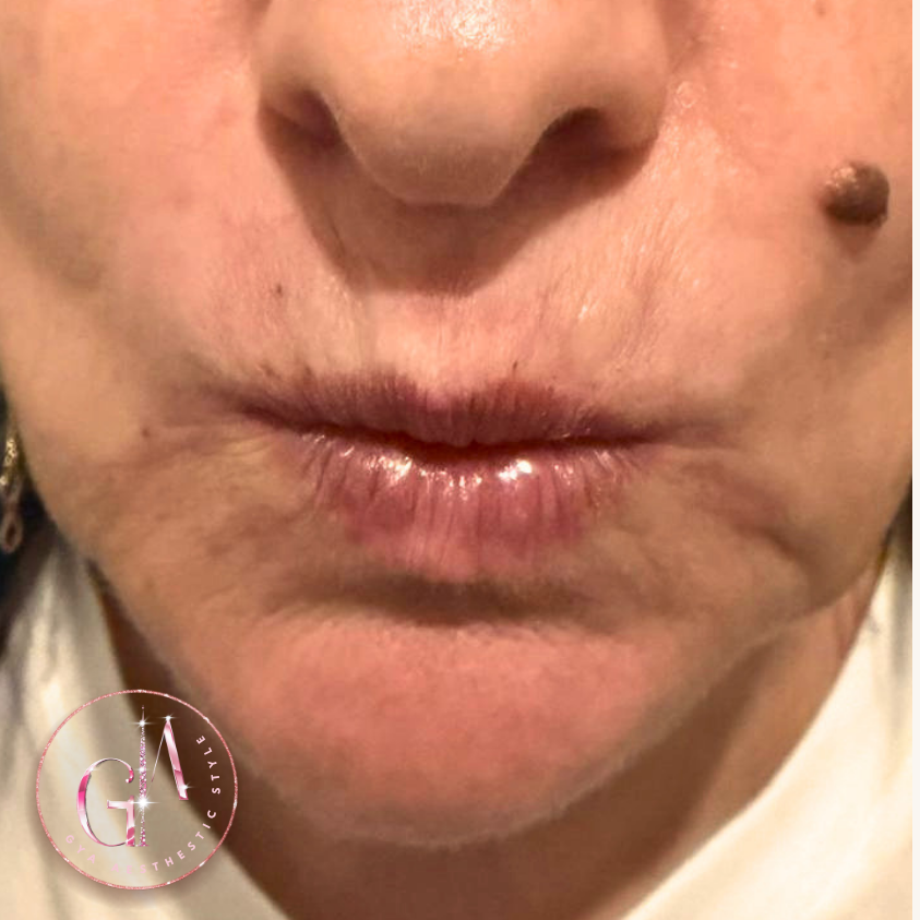 Smoker’s Lines after
