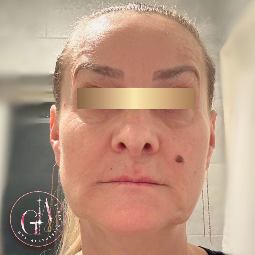 Static lines around the nose and the mouth. Forehead lines. Cheeks volume. Contoured chin.  after