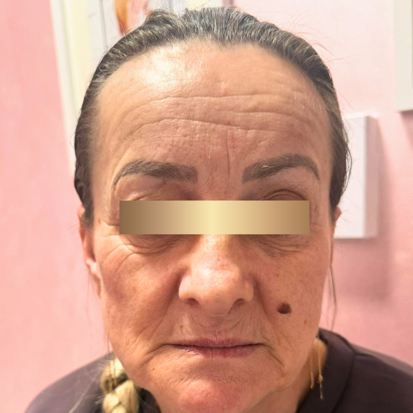 Static lines around the nose and the mouth. Forehead lines. Cheeks volume. Contoured chin.  before