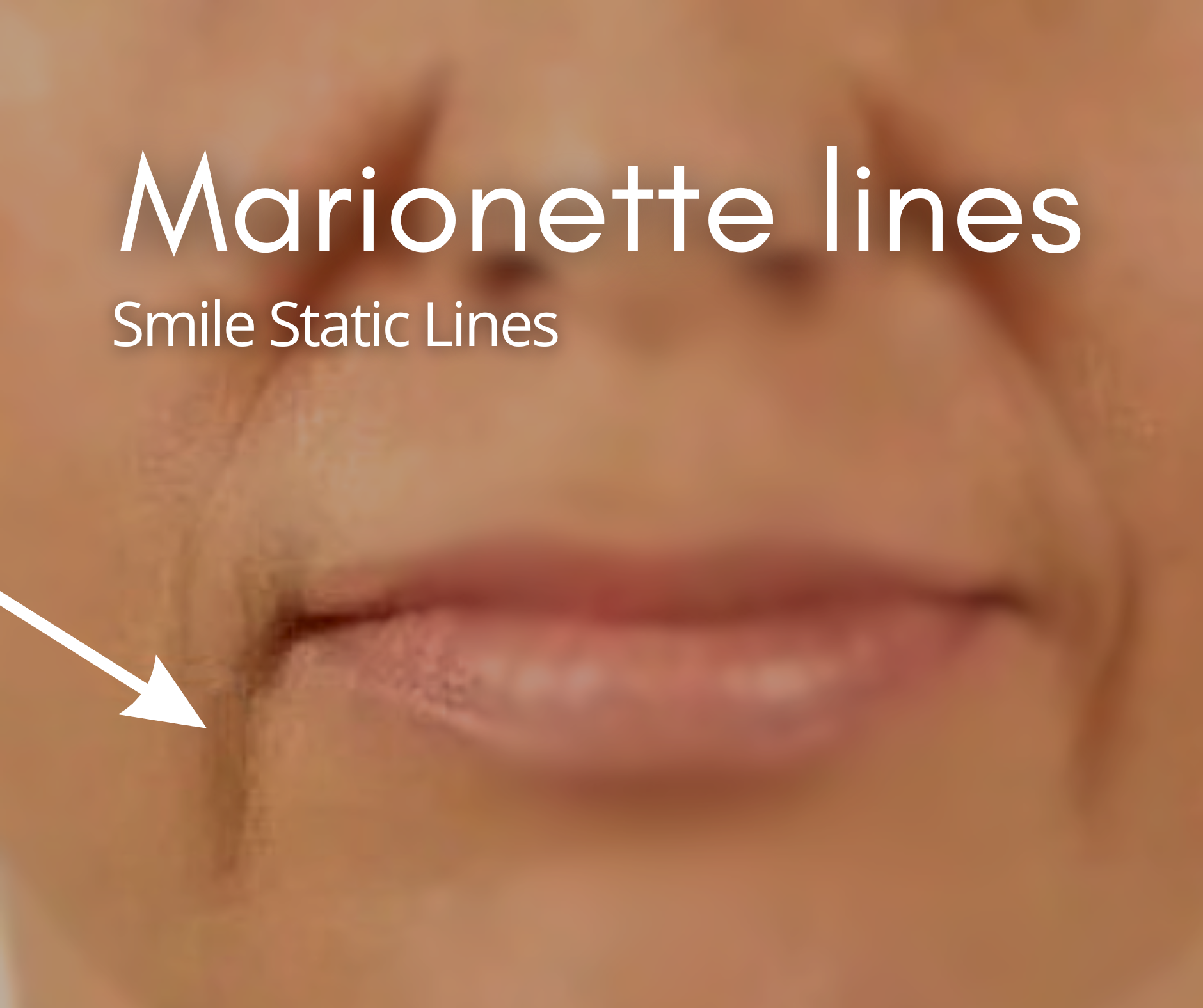 Marionette Lines