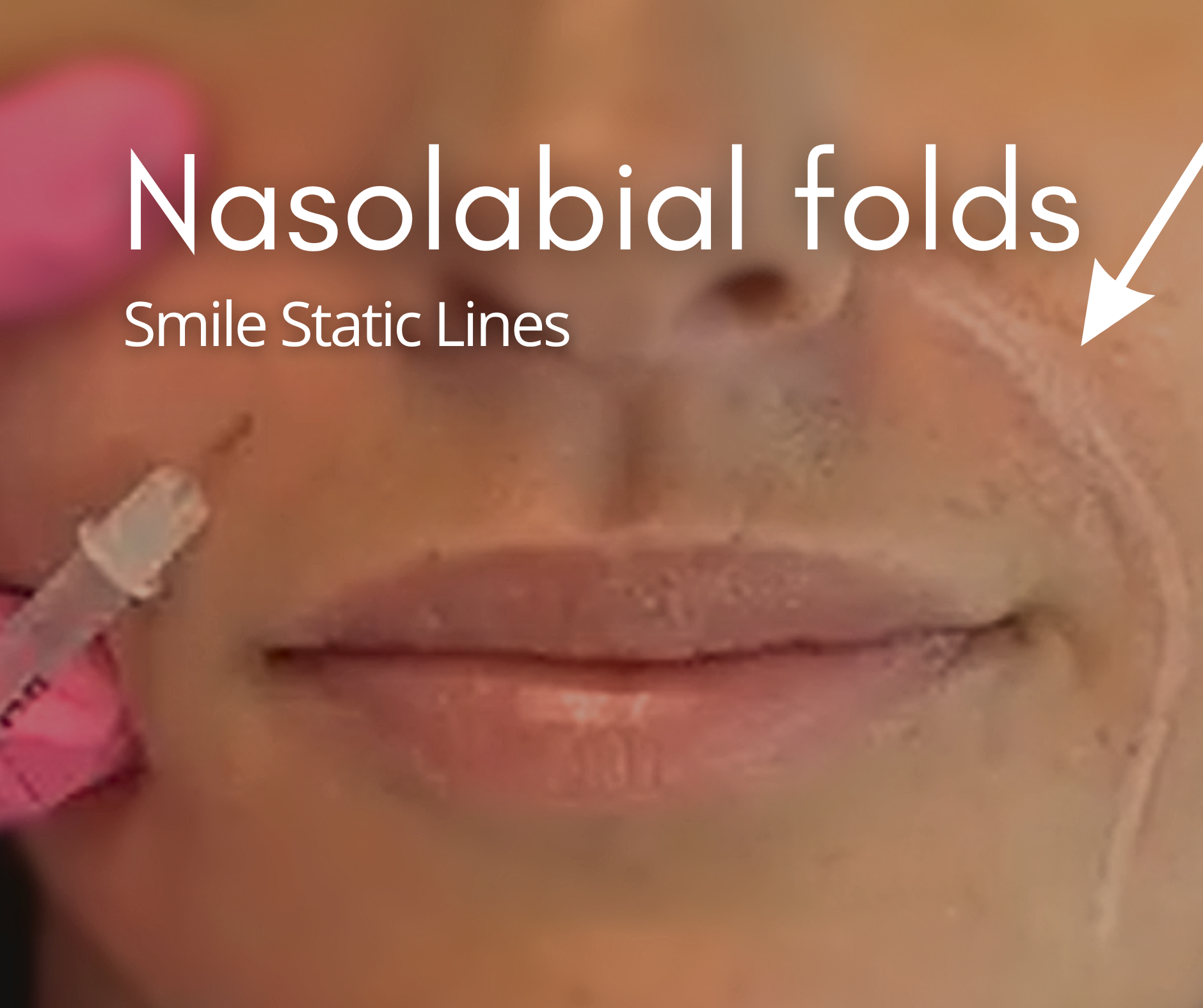 Nasolabil Folds